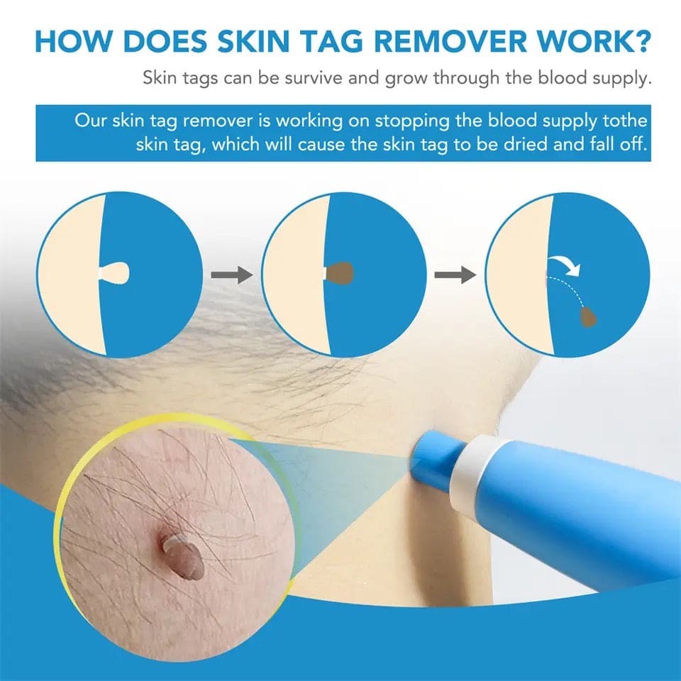 Skin Tag Remover, 2 In1 Painless Auto Skin Tag Remover, Mole Wart Removal Kit, Micro Skin Tag Remover Skin Tag Remover, 2 In1 Painless Auto Skin Tag Remover, Mole Wart Removal Kit, Micro Skin Tag Remover